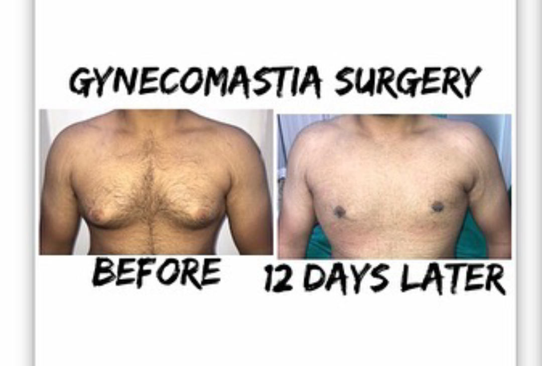 Gynaecomastia, or Male Breast, Correction: Flat Chest Guaranteed!