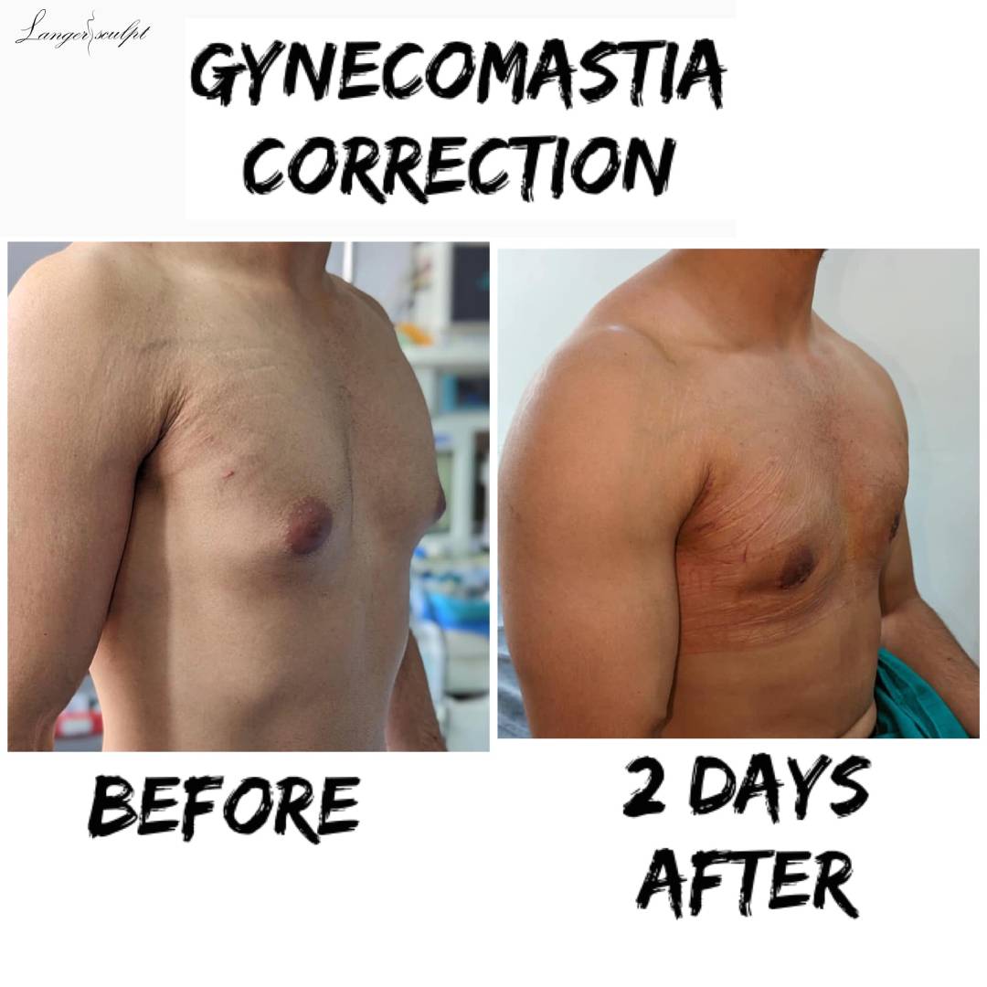 Which surgeon is best for gynecomastia?
