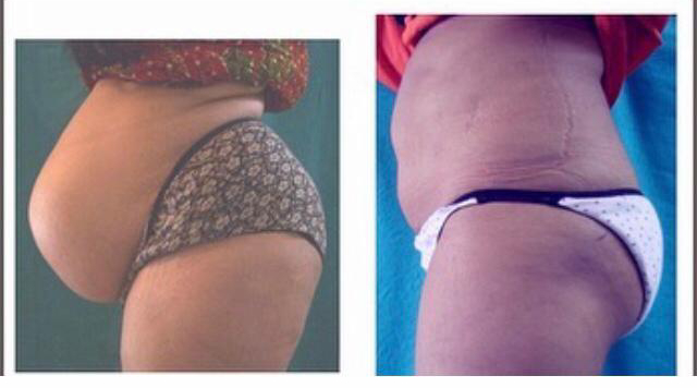 Get a tummy tuck...for a wow body contour!
