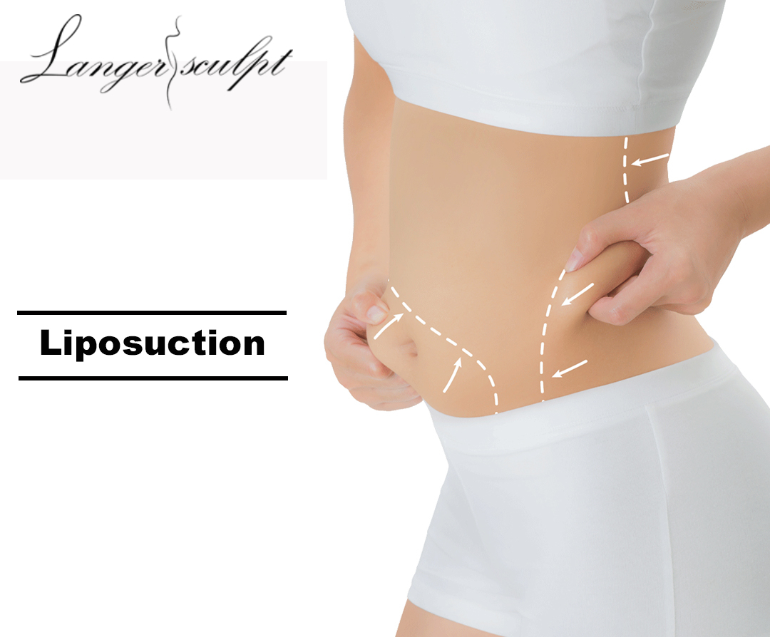 Liposuction Treatment: A Guide to Achieve Your Body Goals