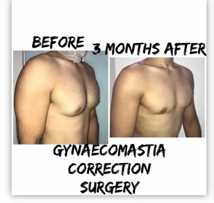 Is it worth getting gynecomastia surgery?