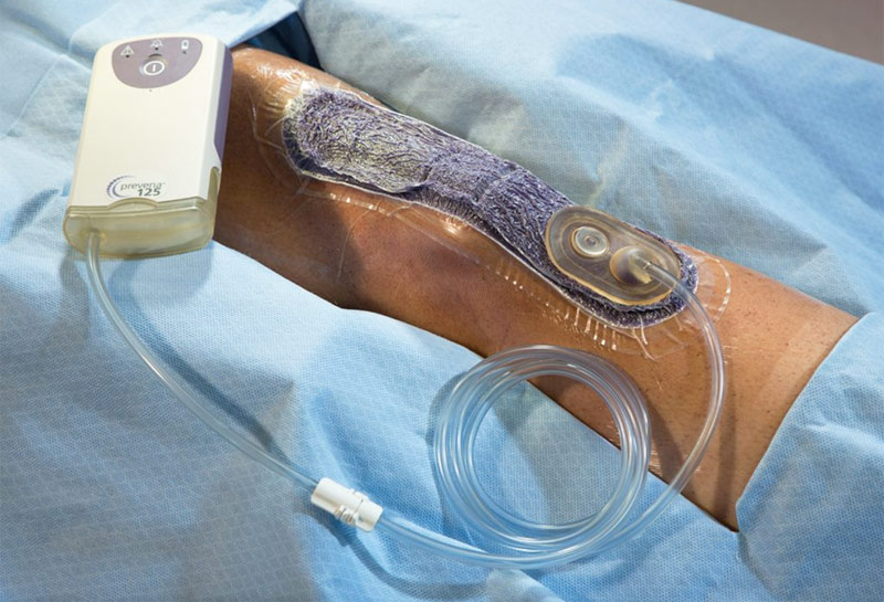 Negative pressure wound therapy as an adjunct in healing of chronic wounds