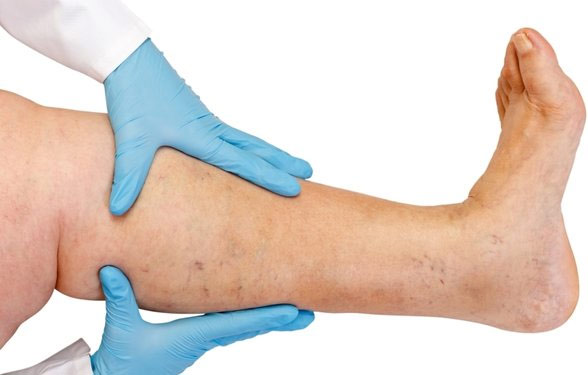 Leg ulcers: An Indian perspective