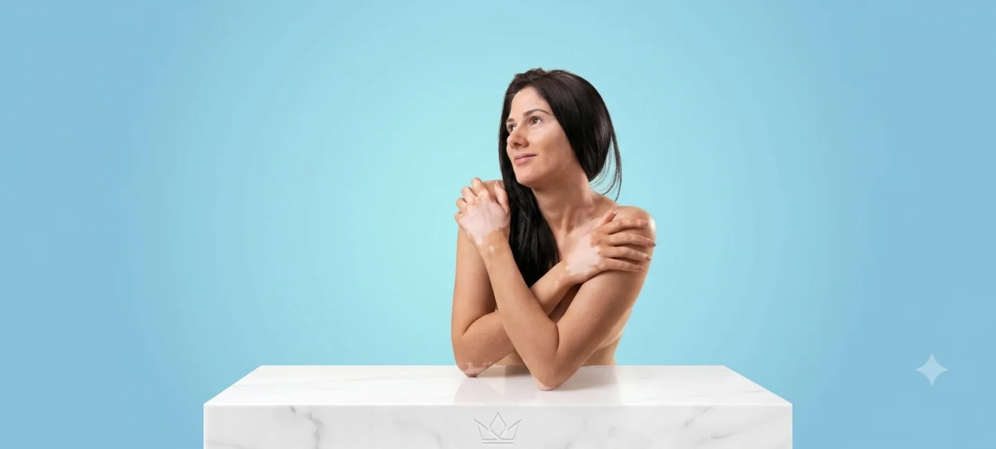 Vitiligo Treatment In Delhi