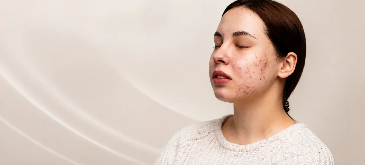 Best Scar Treatment in Delhi