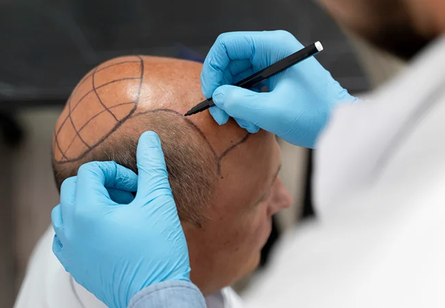 Hair Transplant Surgery in Delhi