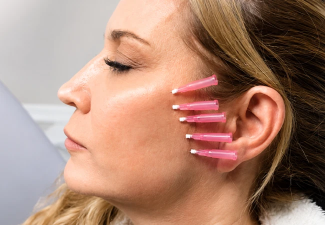 Thread Lift Treatment in Delhi