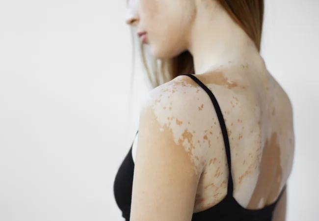 Vitiligo Treatment In Delhi