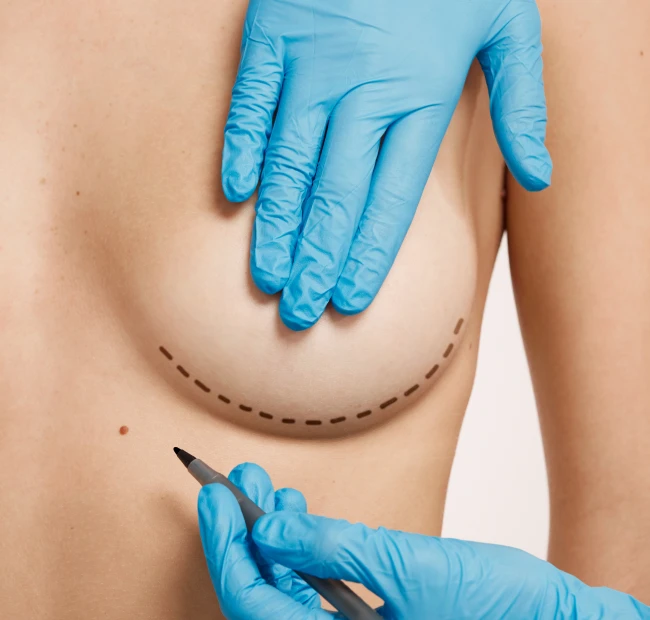 What is Breast Reduction Surgery?