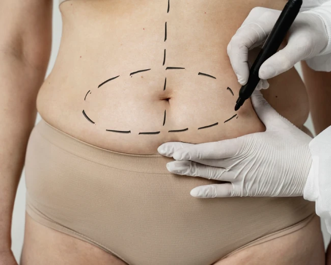 What happens after tummy tuck surgery?
