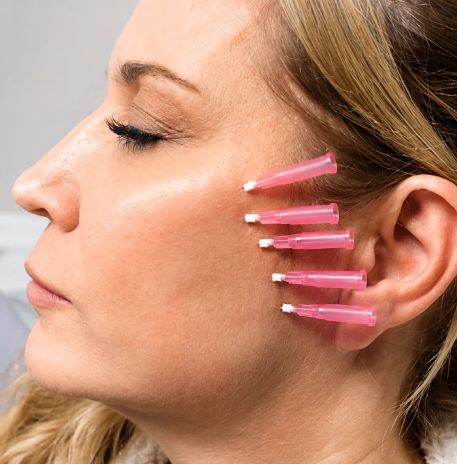 Areas That Can Be Treated With Thread Lift