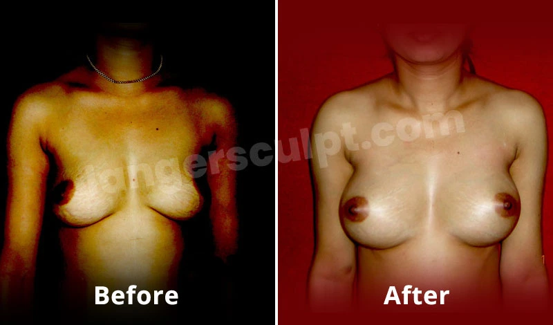 Breast