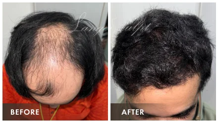 Hair Transplant