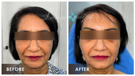 Browlift