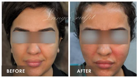 Facial Rejuvenation