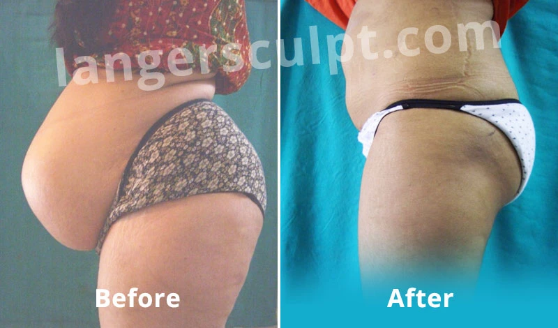 Liposuction & Body Contouring Case 1