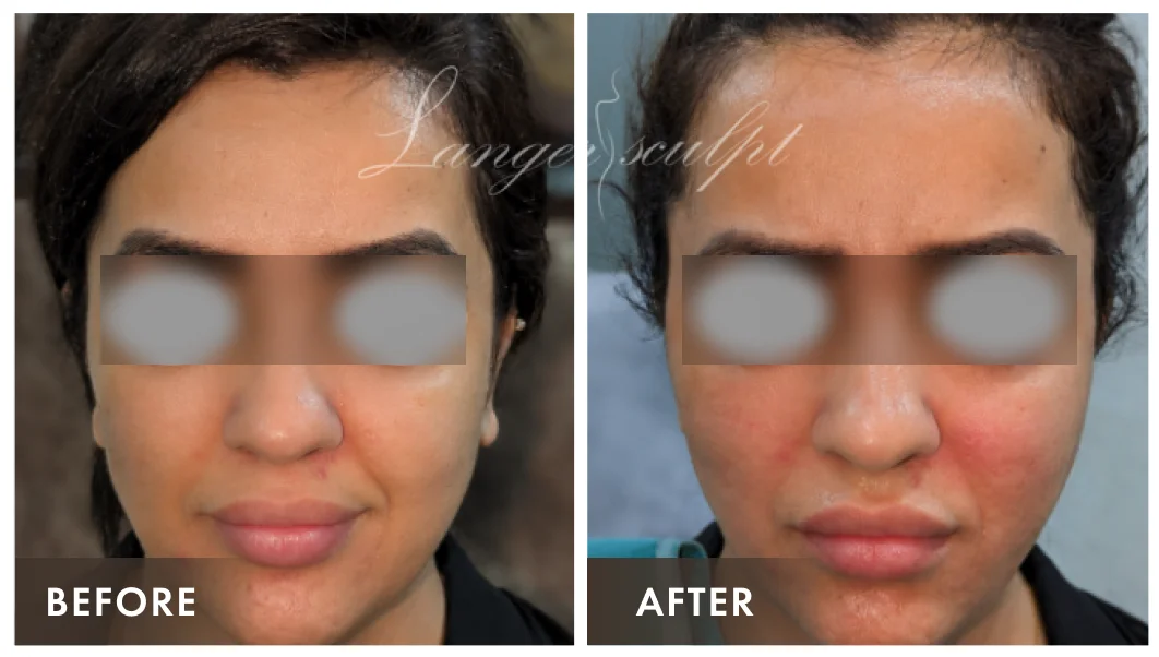 Facial Rejuvenation