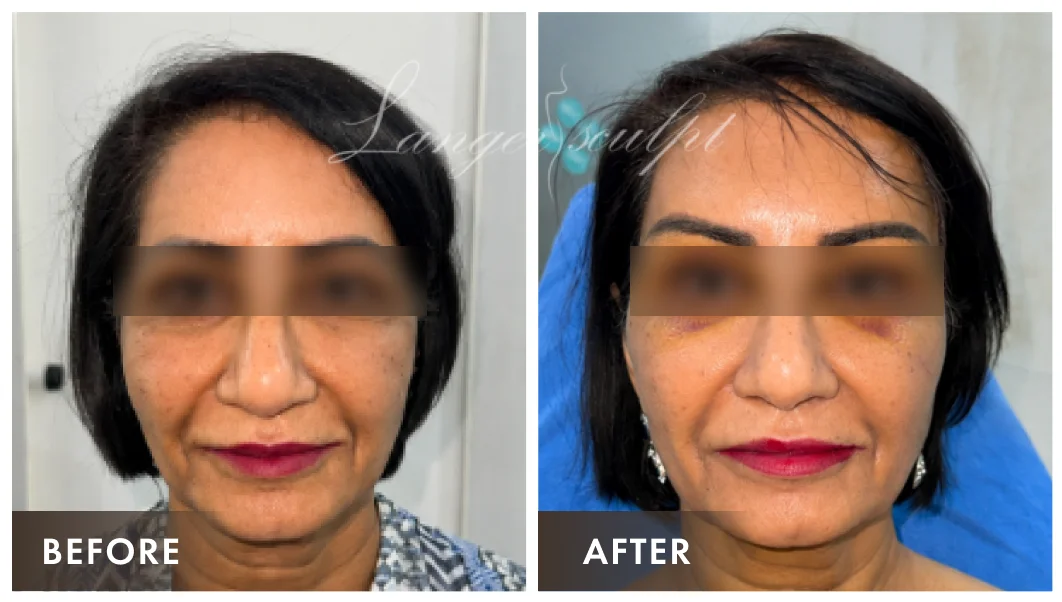 Browlift