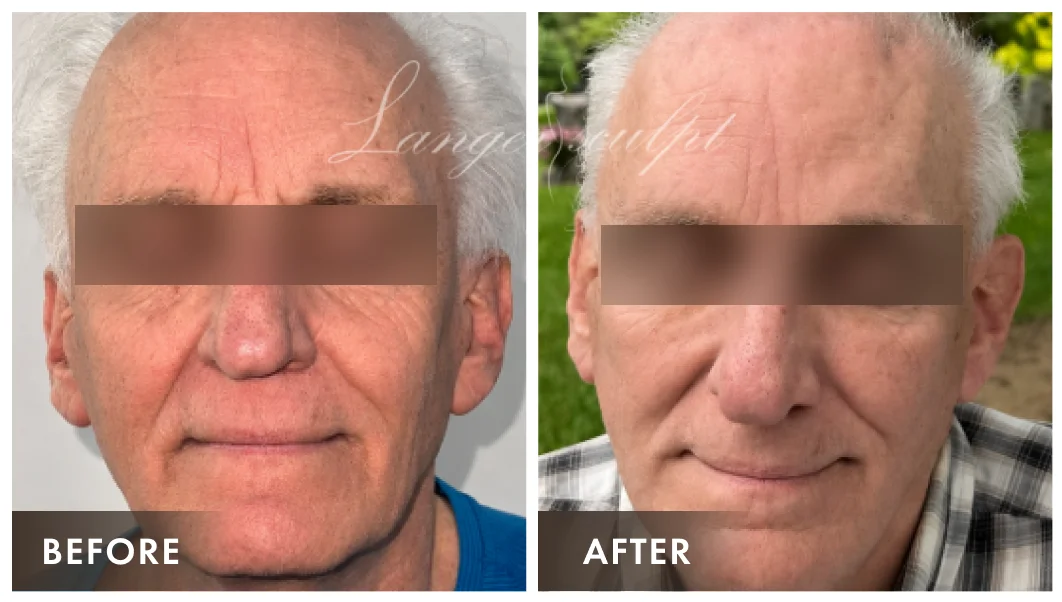 Face & Neck Lift